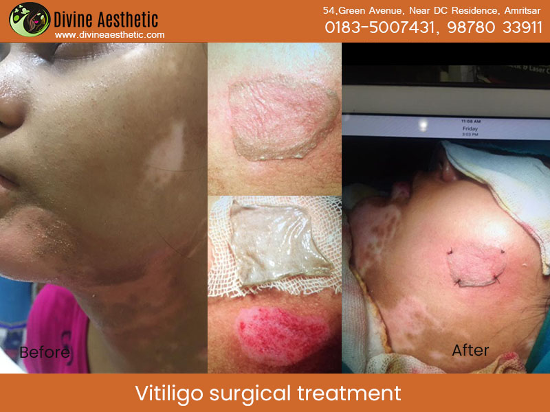 Vitiligo-surgical-treatment