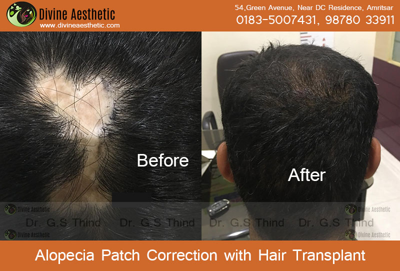 Alopecia-patch-treatment-with-hair-transplant
